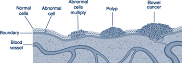 Colon Cancer Screening